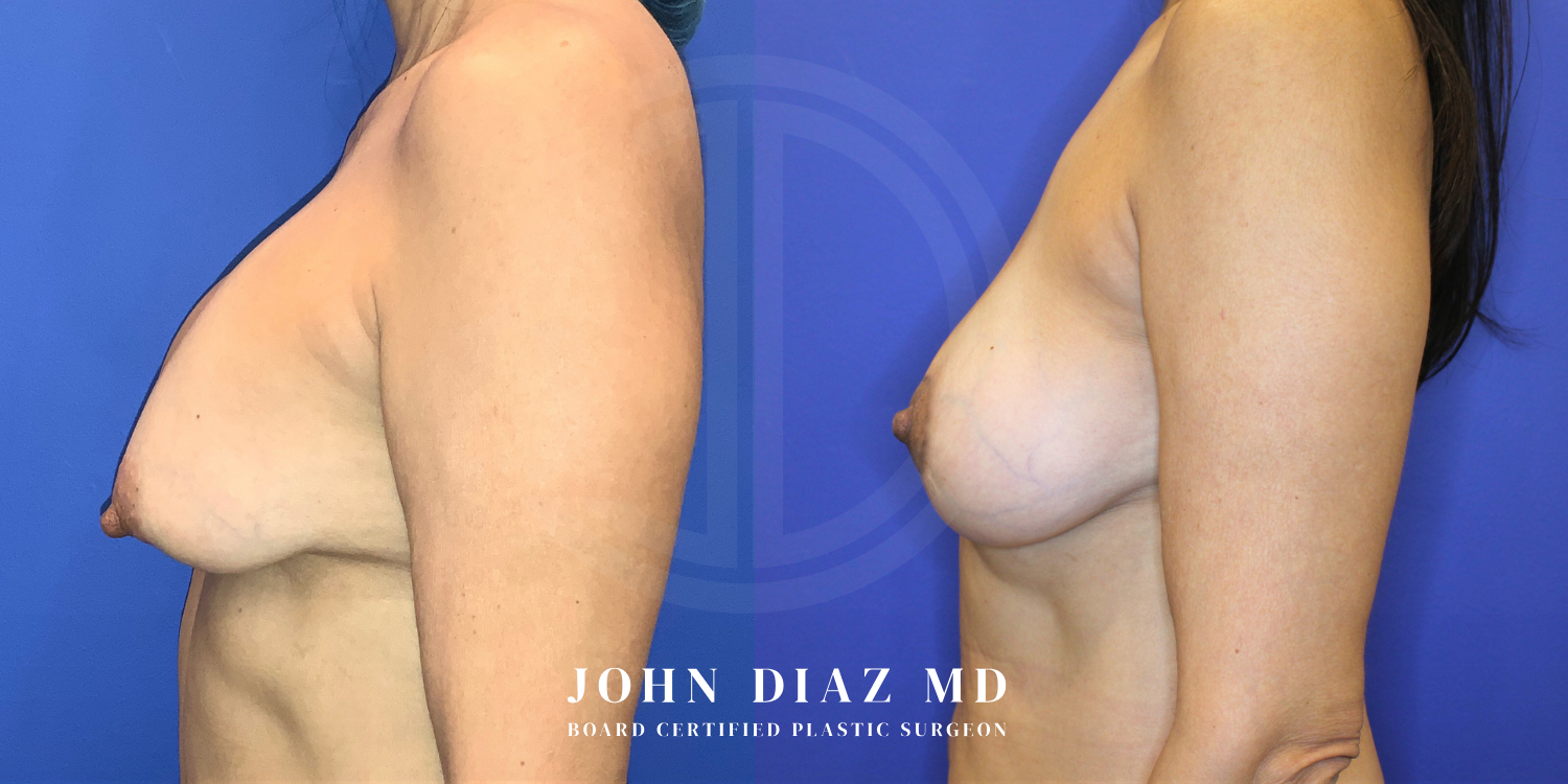 Dr John Diaz Before and After | Breast Revision, Capsular Contracture