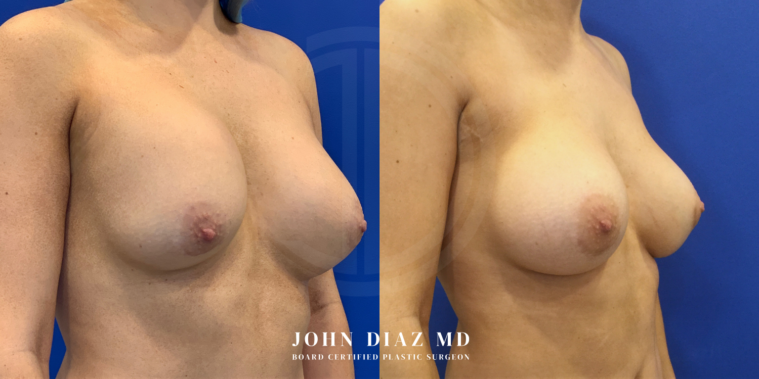 Dr John Diaz Before and After | Breast Revision, Capsular Contracture