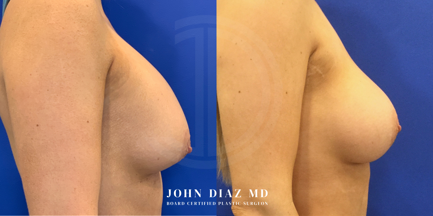 Dr John Diaz Before and After | Breast Revision, Capsular Contracture
