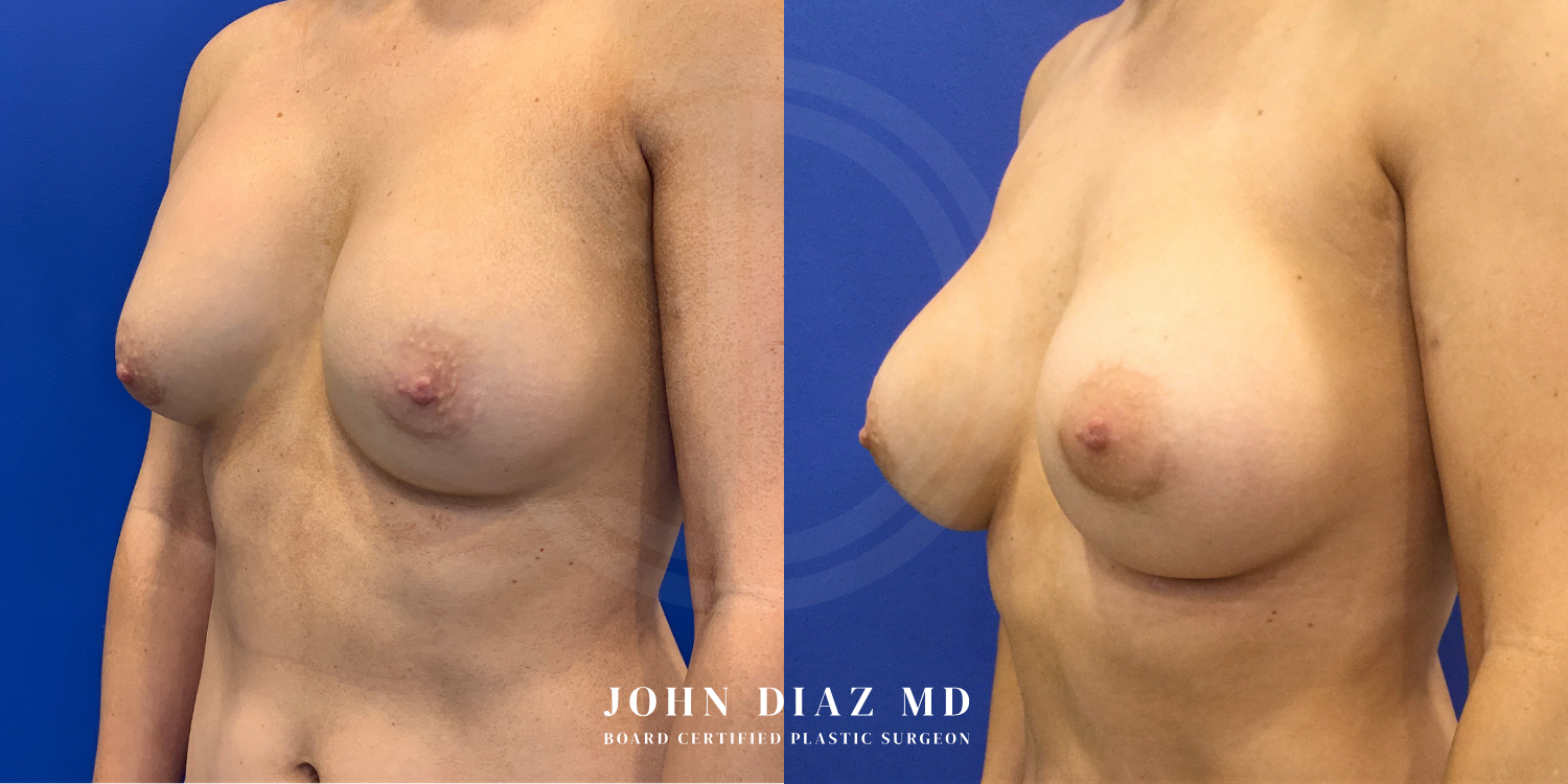 Dr John Diaz Before and After | Breast Revision, Capsular Contracture