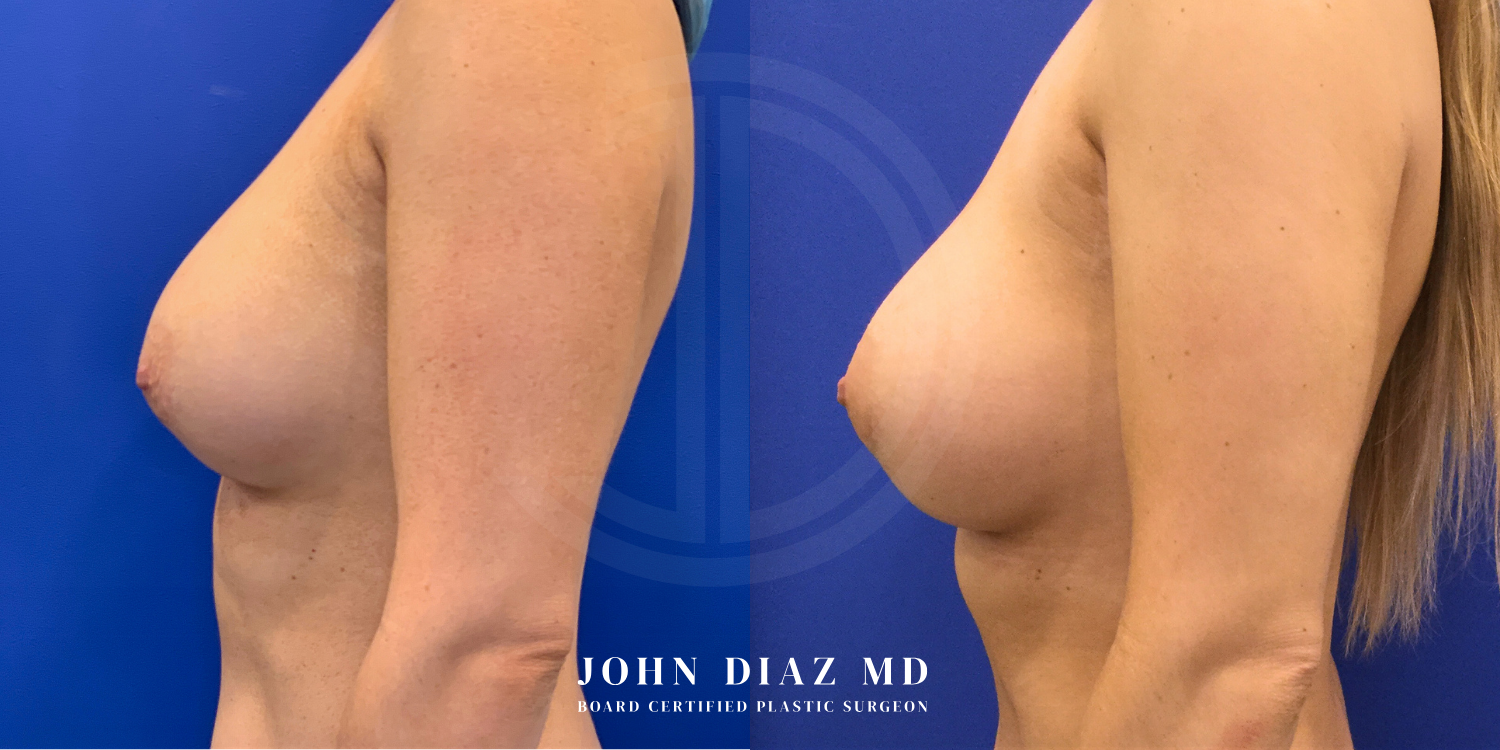 Dr John Diaz Before and After | Breast Revision, Capsular Contracture