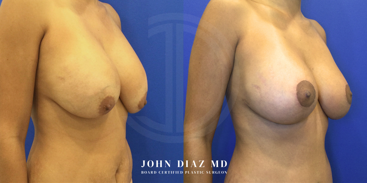 Dr John Diaz Before and After | Breast Revision, Capsular Contracture