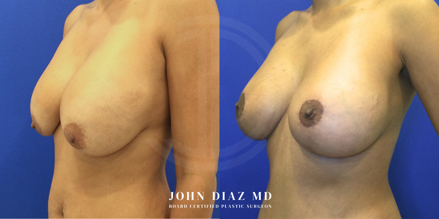 Dr John Diaz Before and After | Breast Revision, Capsular Contracture