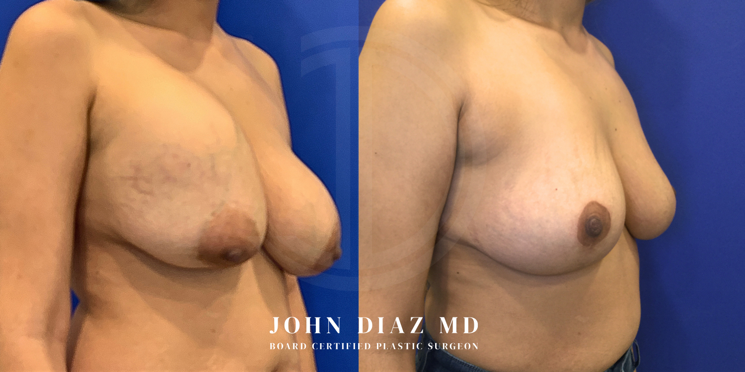 Dr John Diaz Before and After | Breast Revision, Capsular Contracture