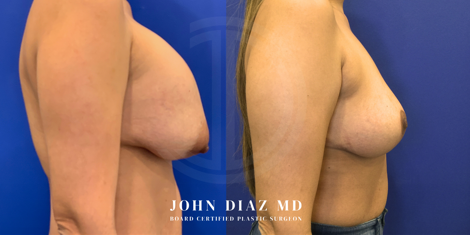 Dr John Diaz Before and After | Breast Revision, Capsular Contracture