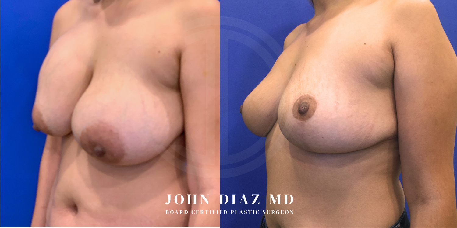 Dr John Diaz Before and After | Breast Revision, Capsular Contracture