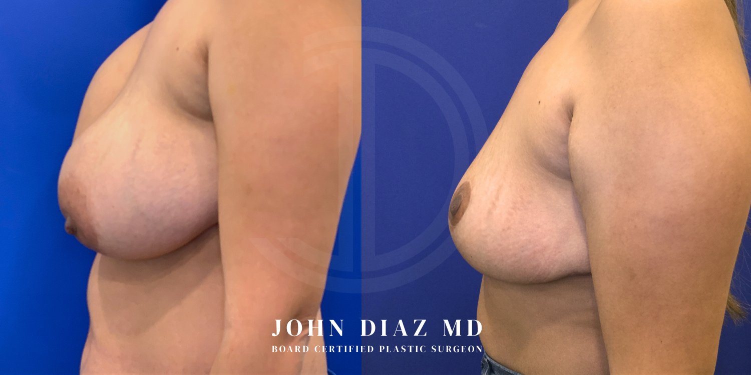 Dr John Diaz Before and After | Breast Revision, Capsular Contracture