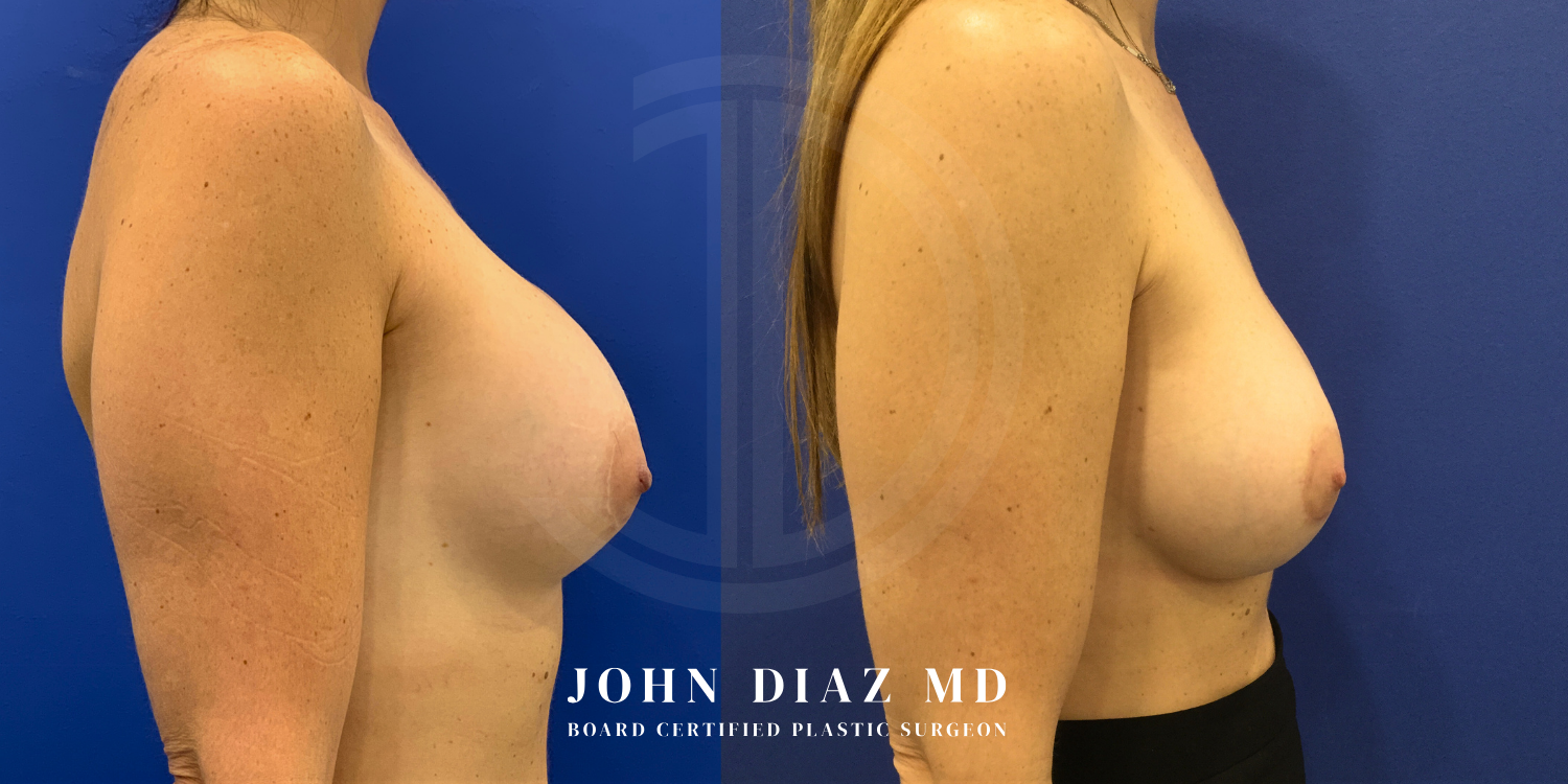 Dr John Diaz Before and After | Breast Revision, Capsular Contracture