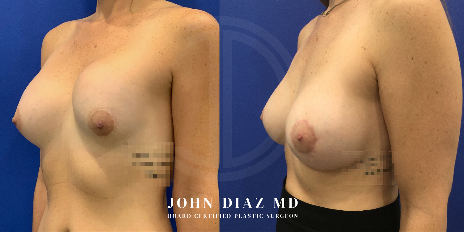 Dr John Diaz Before and After | Breast Revision, Capsular Contracture