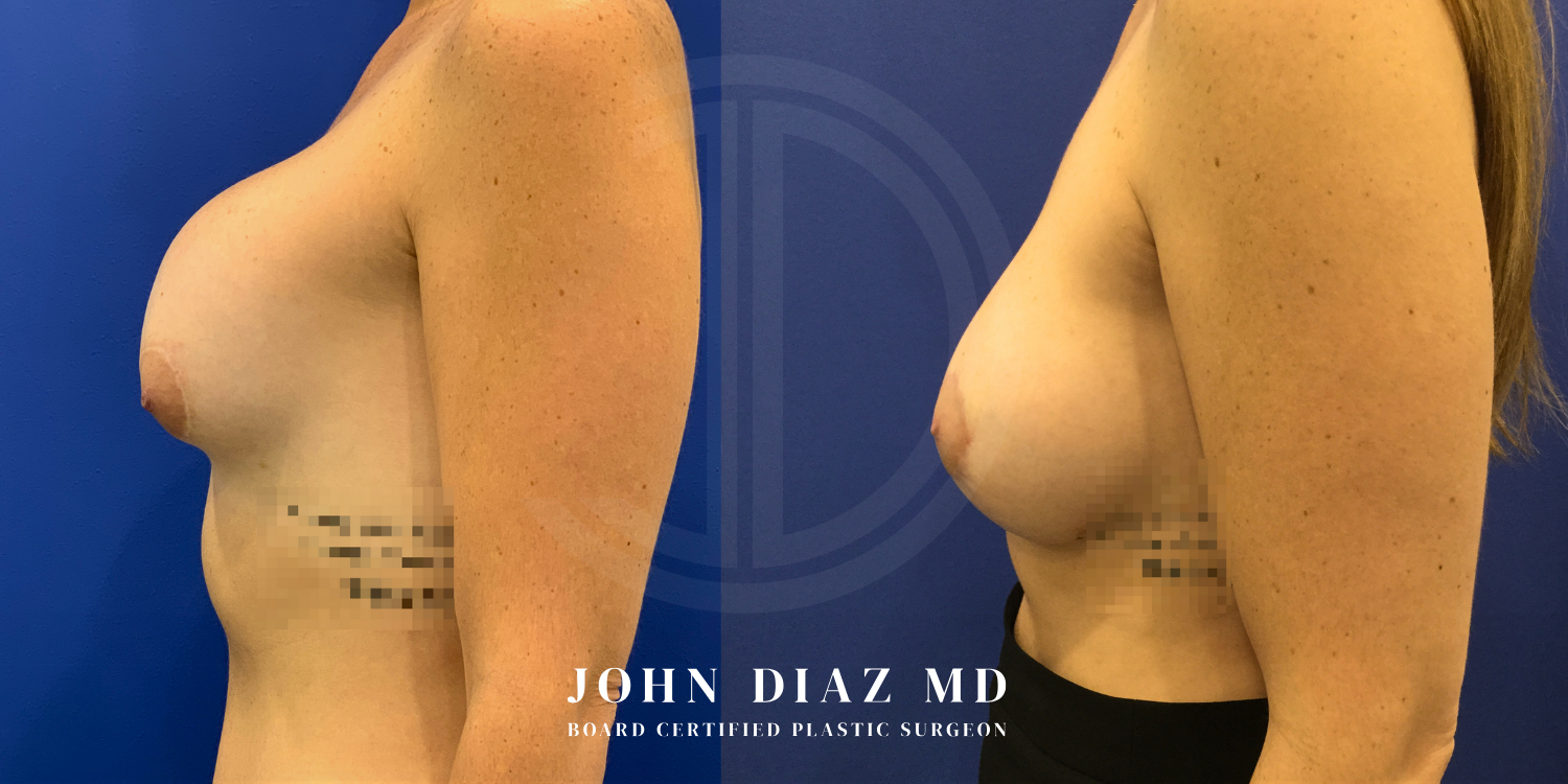 Dr John Diaz Before and After | Breast Revision, Capsular Contracture