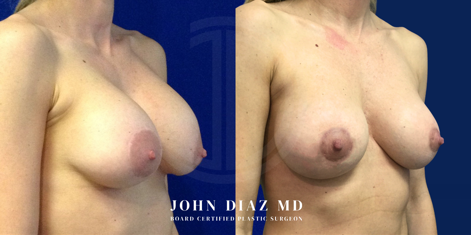 Dr John Diaz Before and After | Breast Revision, Capsular Contracture