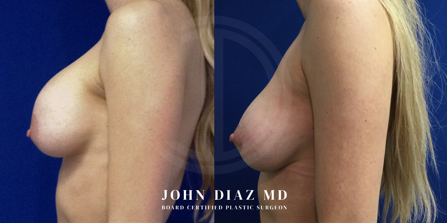 Dr John Diaz Before and After | Breast Revision, Capsular Contracture