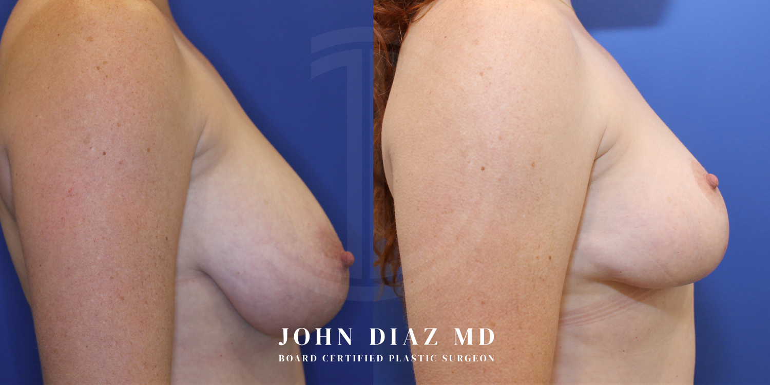 Dr John Diaz Before and After | Breast Revision, Capsular Contracture
