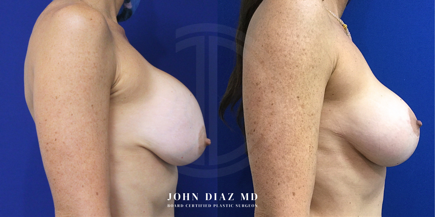 Dr John Diaz Before and After | Breast Revision, Capsular Contracture