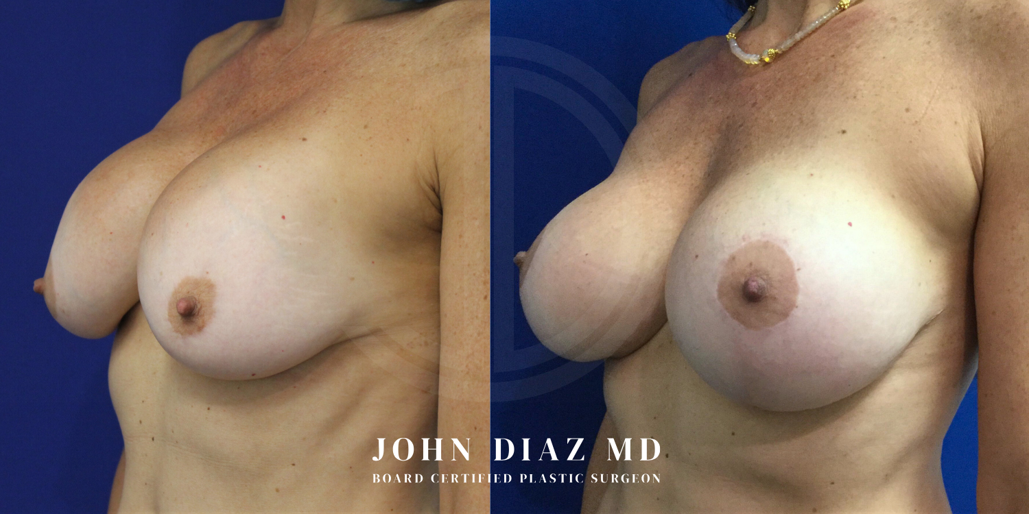 Dr John Diaz Before and After | Breast Revision, Capsular Contracture