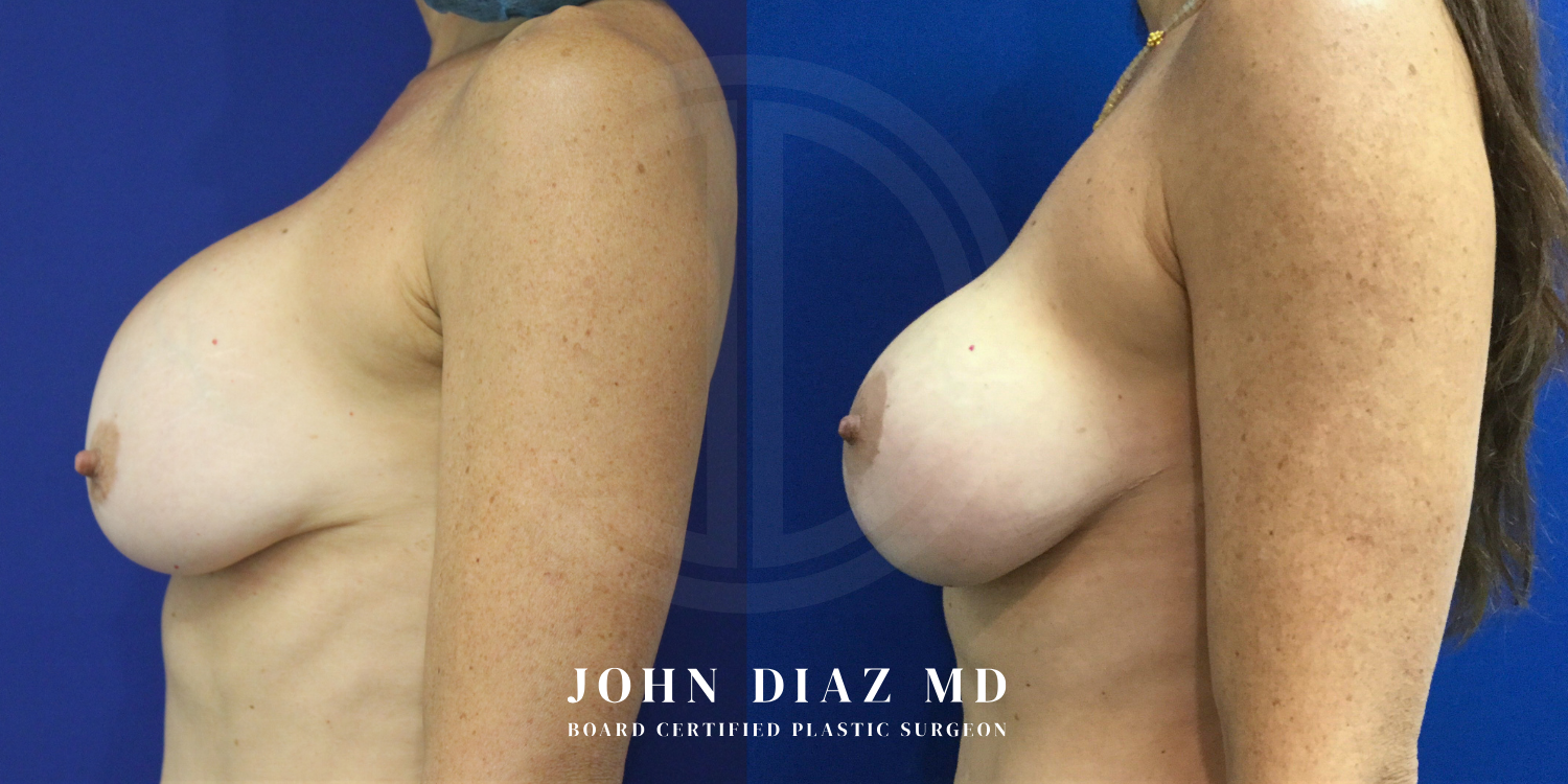Dr John Diaz Before and After | Breast Revision, Capsular Contracture
