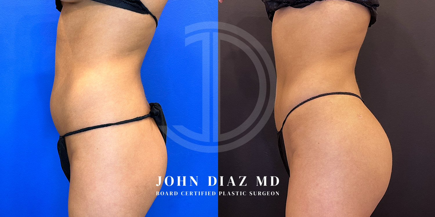 Dr John Diaz Before and After | Liposuction