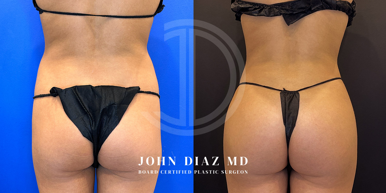 Dr John Diaz Before and After | Liposuction