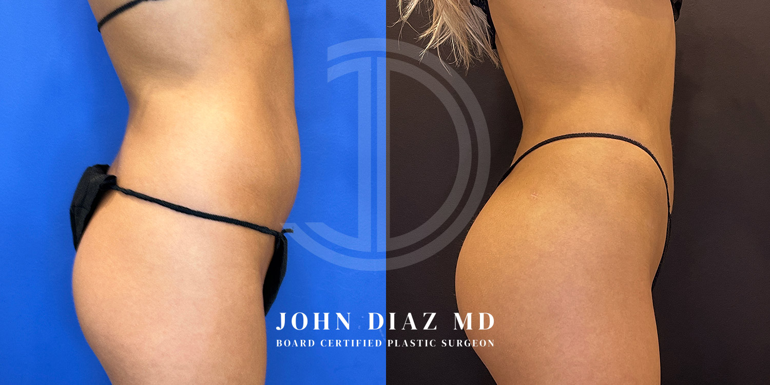 Dr John Diaz Before and After | Liposuction