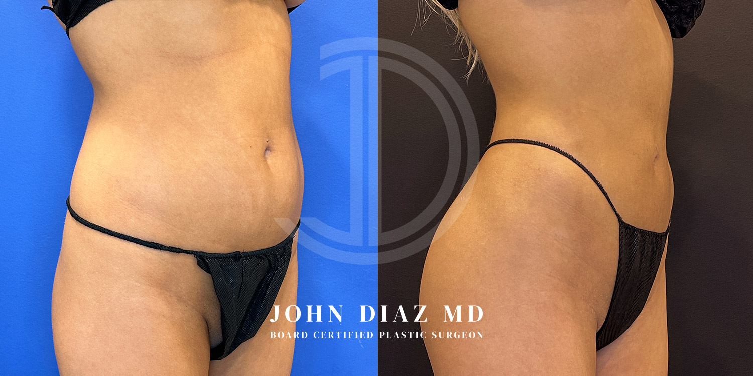Dr John Diaz Before and After | Liposuction