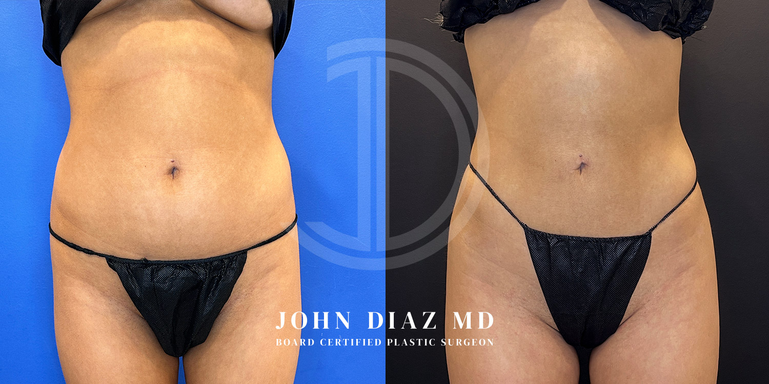 Dr John Diaz Before and After | Liposuction