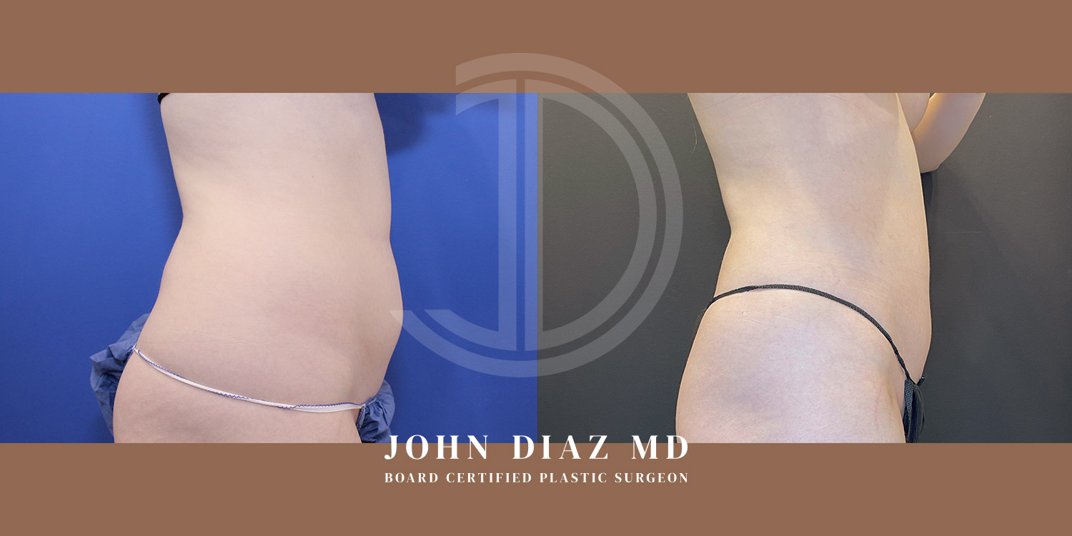 Dr John Diaz Before and After | Liposuction