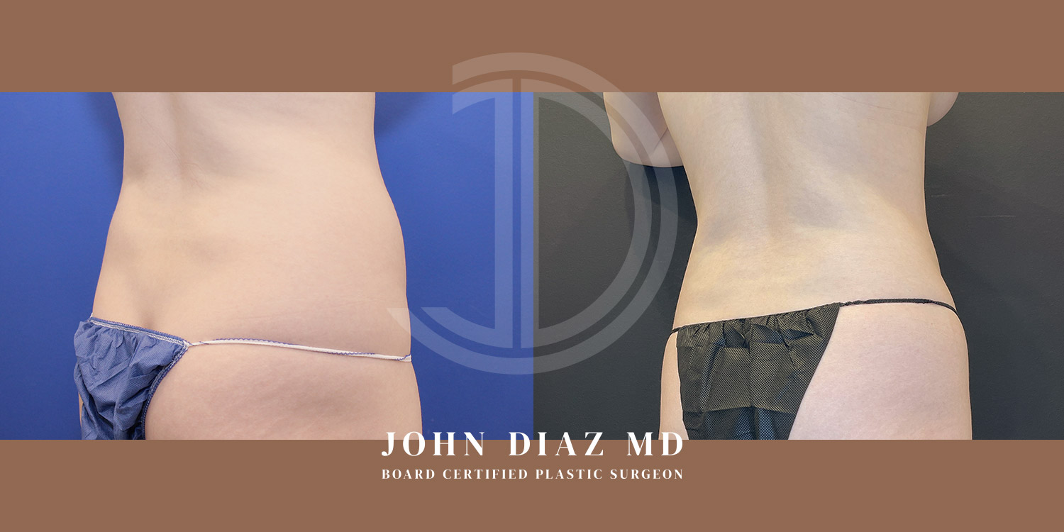 Dr John Diaz Before and After | Liposuction