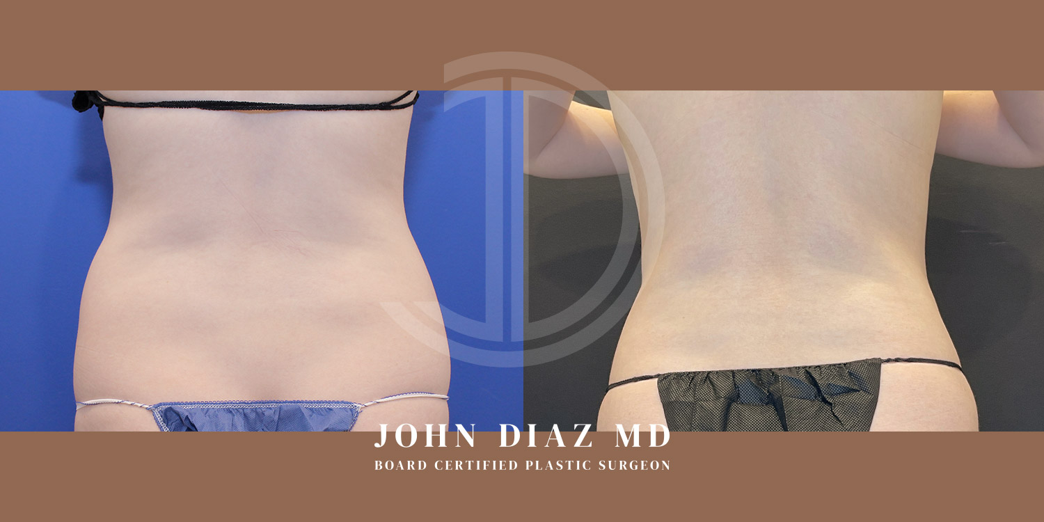 Dr John Diaz Before and After | Liposuction