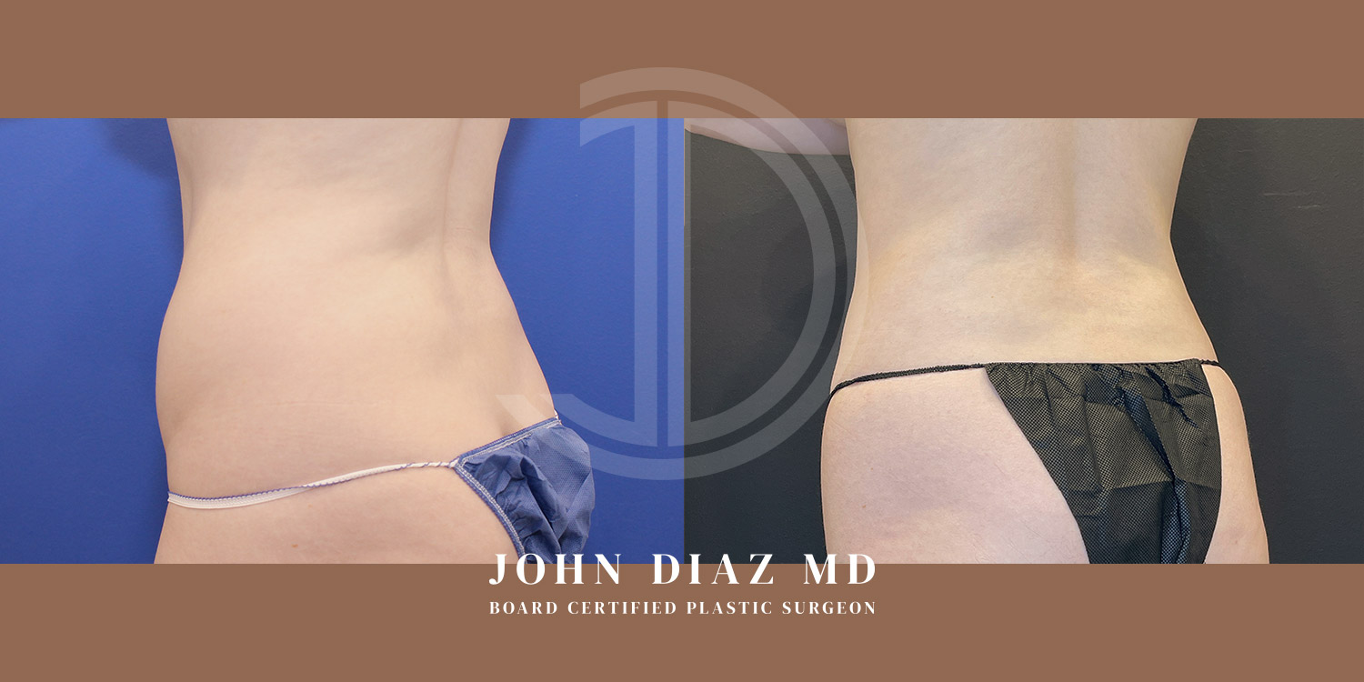Dr John Diaz Before and After | Liposuction