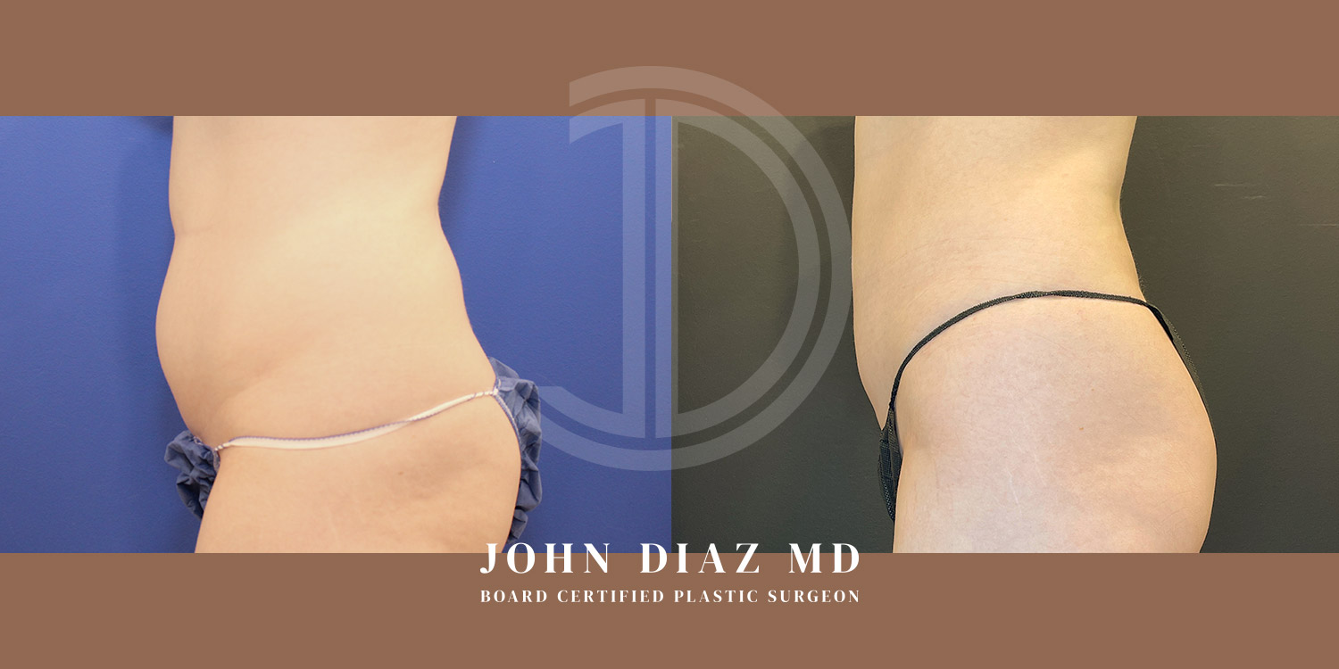 Dr John Diaz Before and After | Liposuction