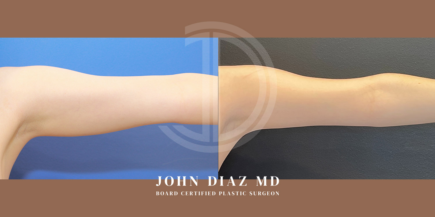 Dr John Diaz Before and After | Liposuction