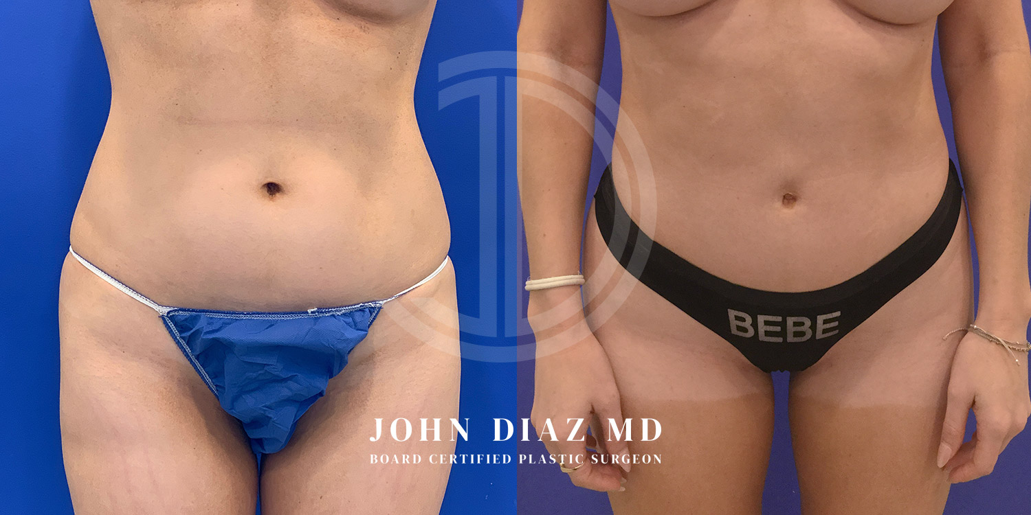 Dr John Diaz Before and After | Liposuction