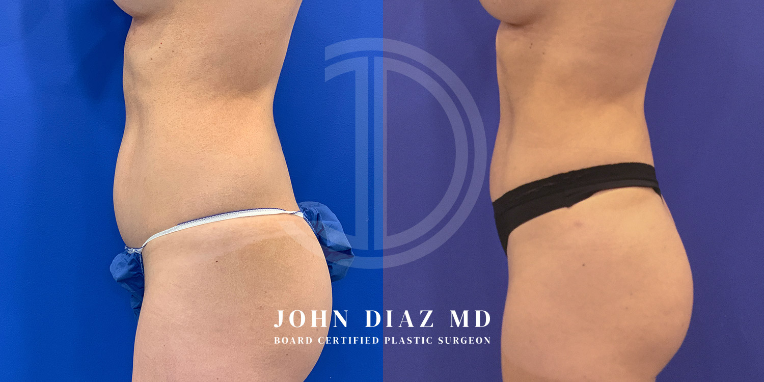 Dr John Diaz Before and After | Liposuction