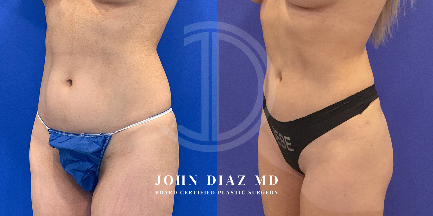 Dr John Diaz Before and After | Liposuction