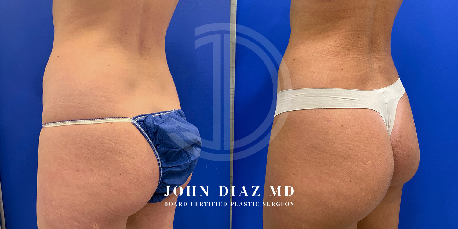 Dr John Diaz Before and After | Liposuction