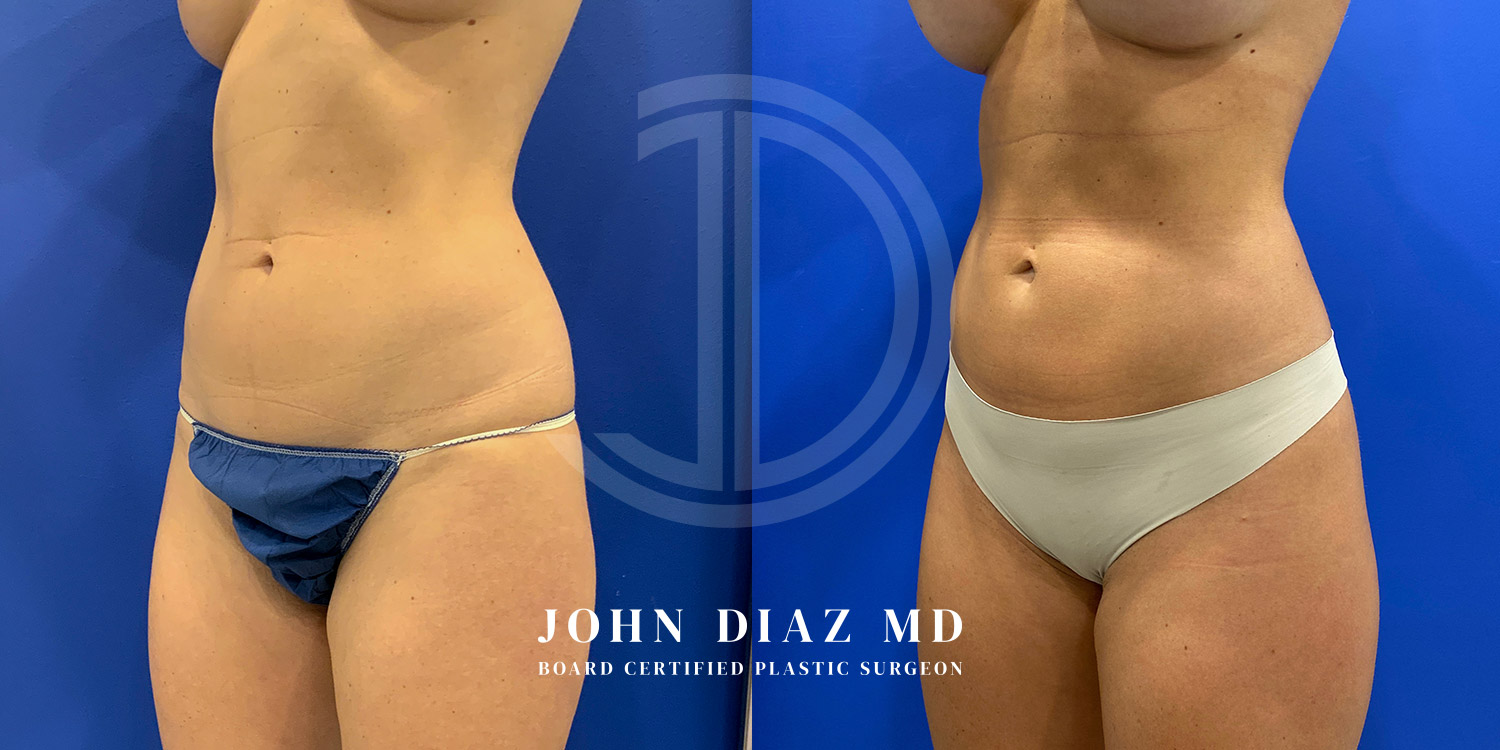 Dr John Diaz Before and After | Liposuction