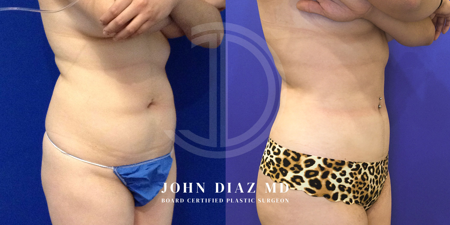 Dr John Diaz Before and After | Liposuction
