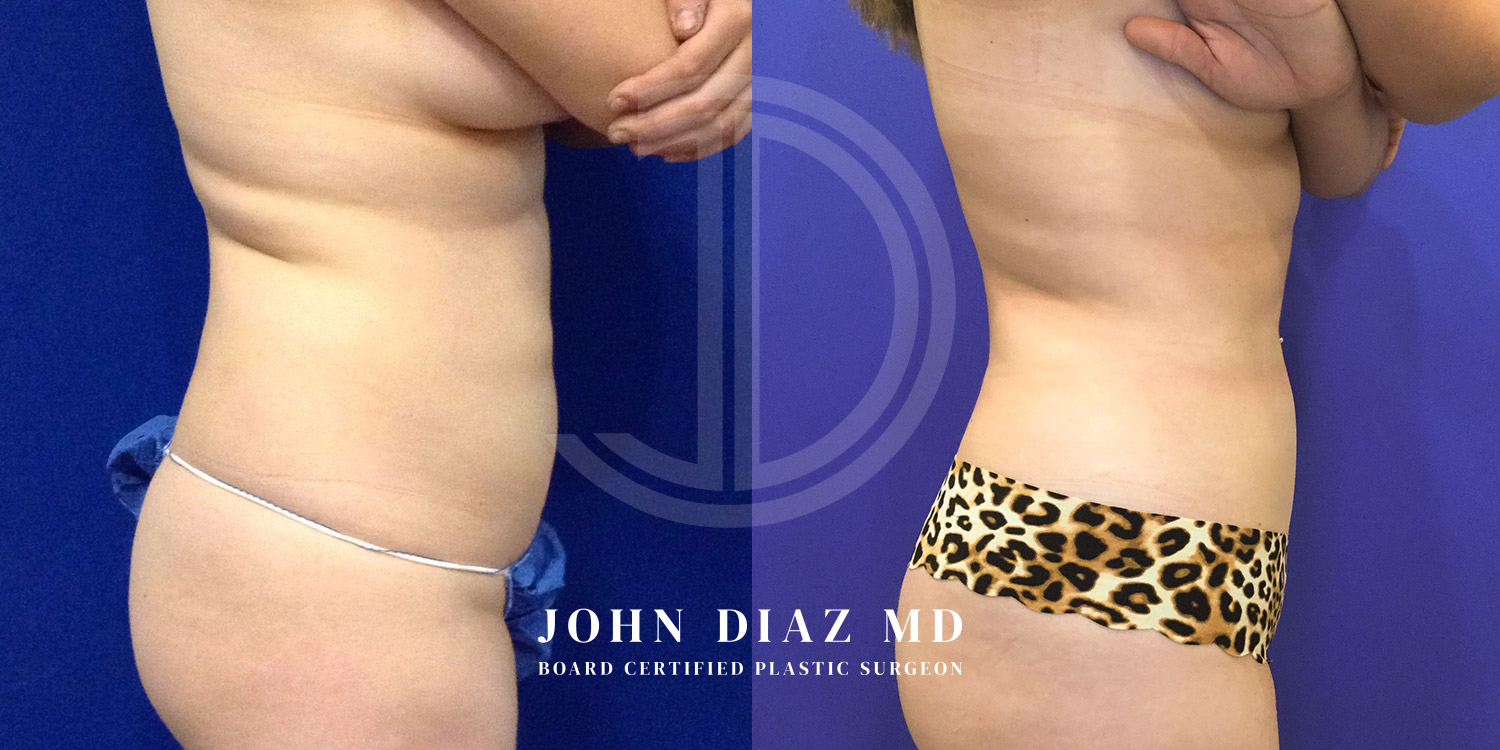 Dr John Diaz Before and After | Liposuction