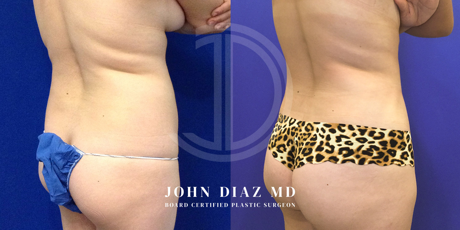 Dr John Diaz Before and After | Liposuction
