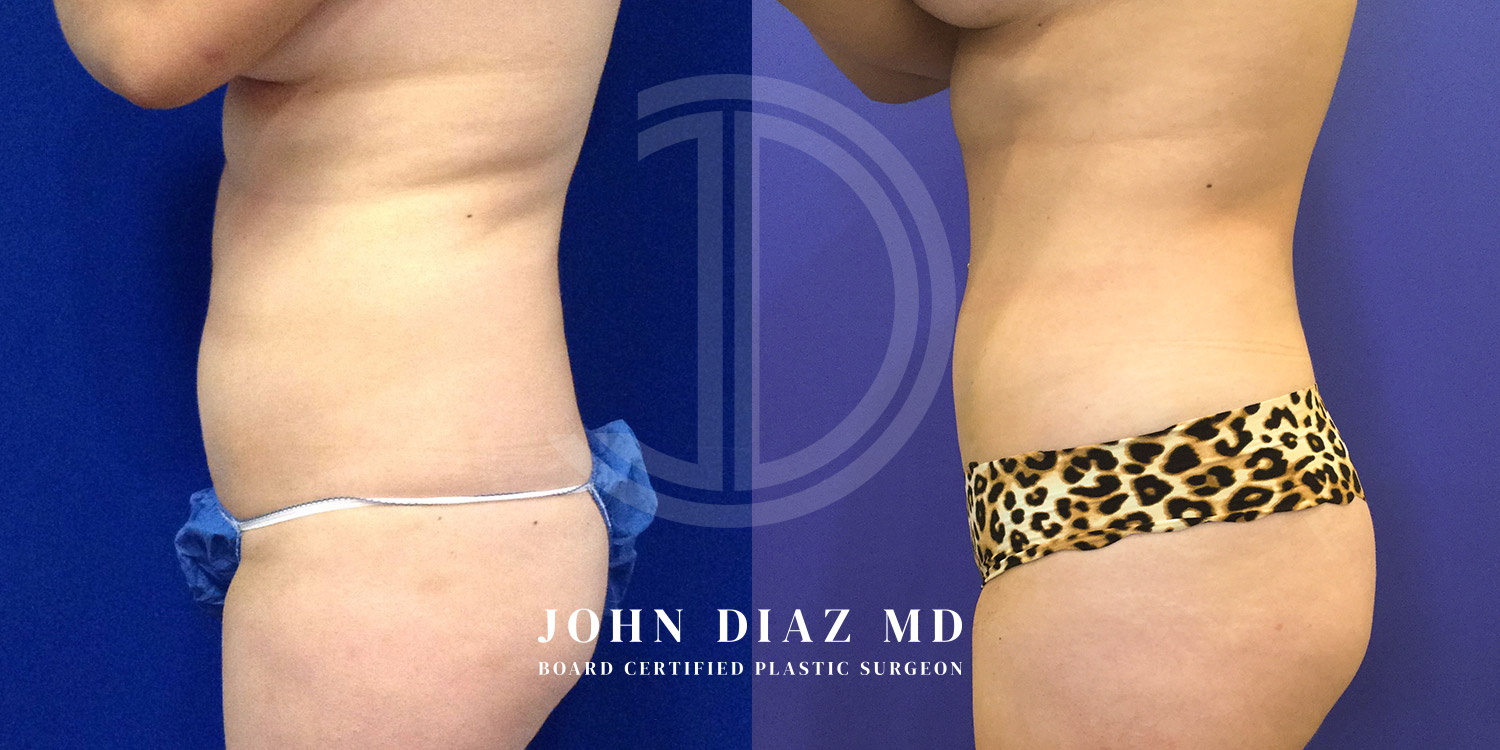 Dr John Diaz Before and After | Liposuction