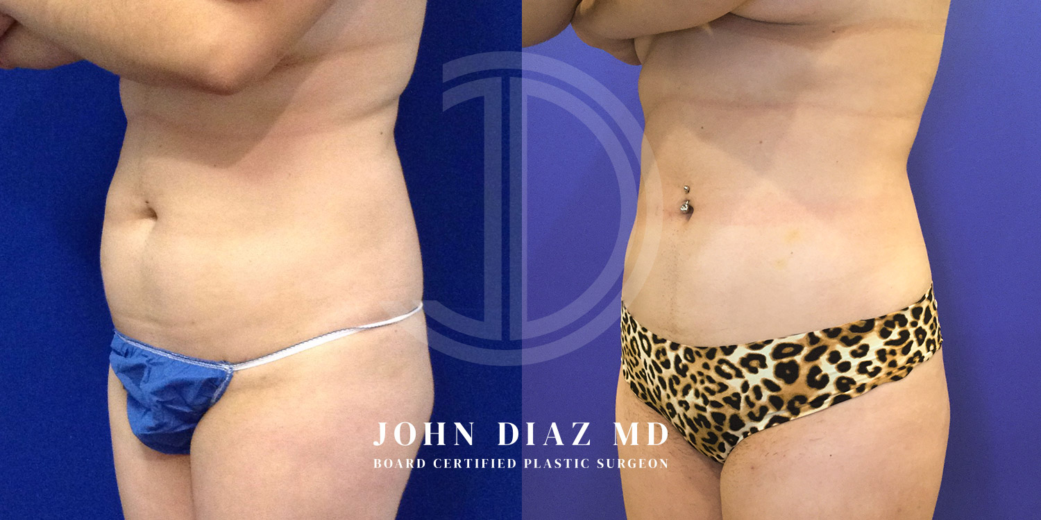 Dr John Diaz Before and After | Liposuction