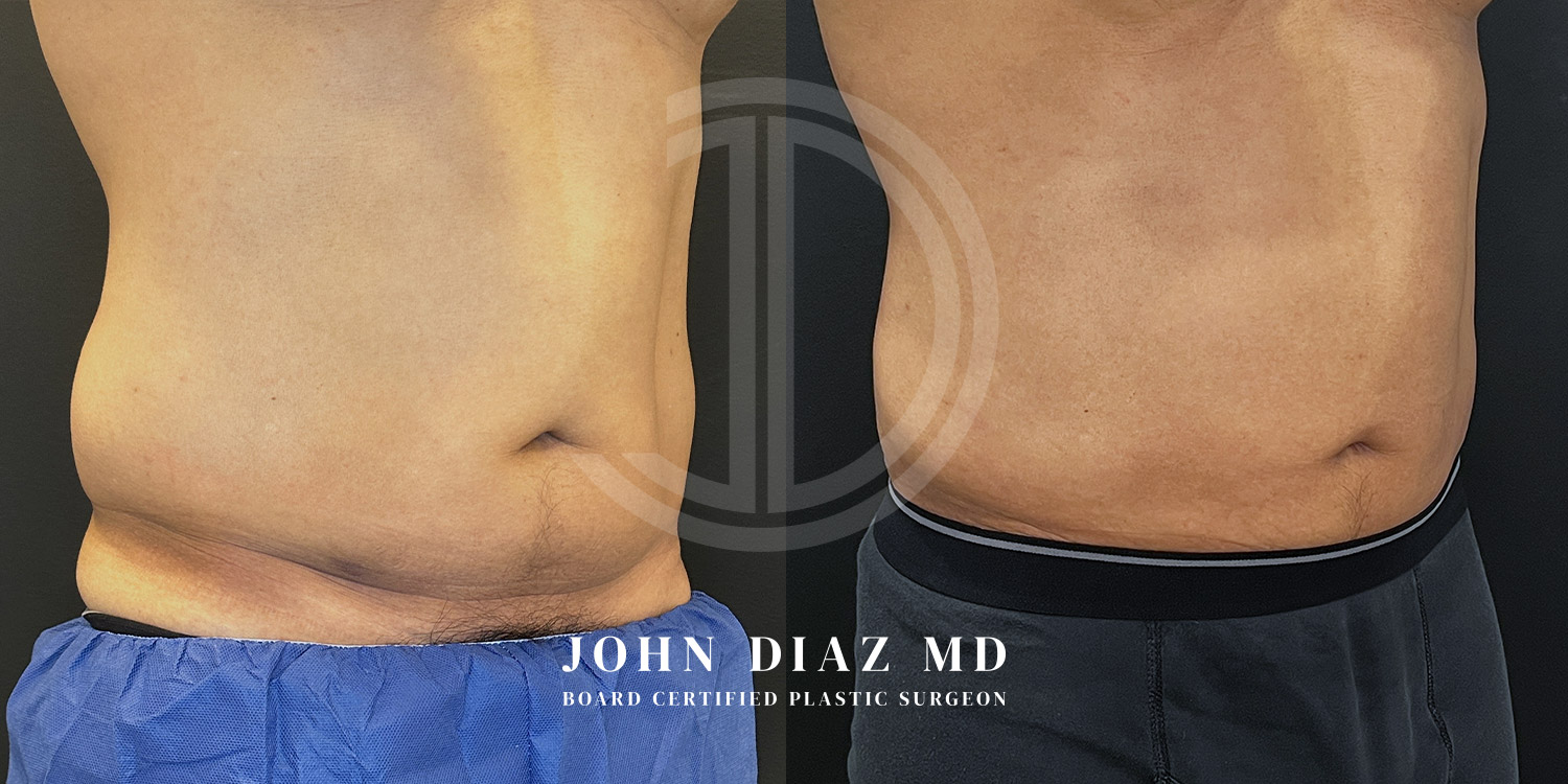 Dr John Diaz Before and After | Liposuction