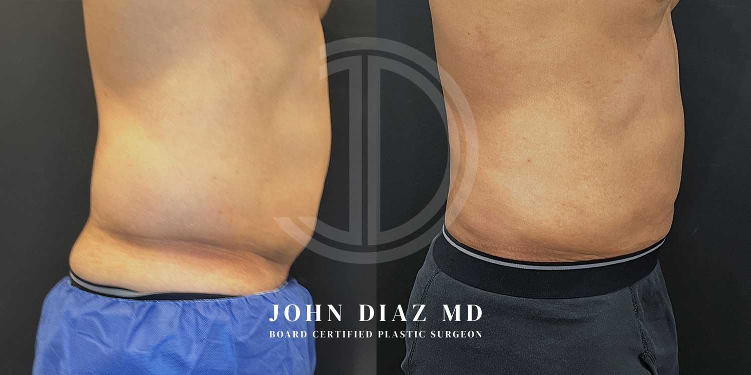 Dr John Diaz Before and After | Liposuction