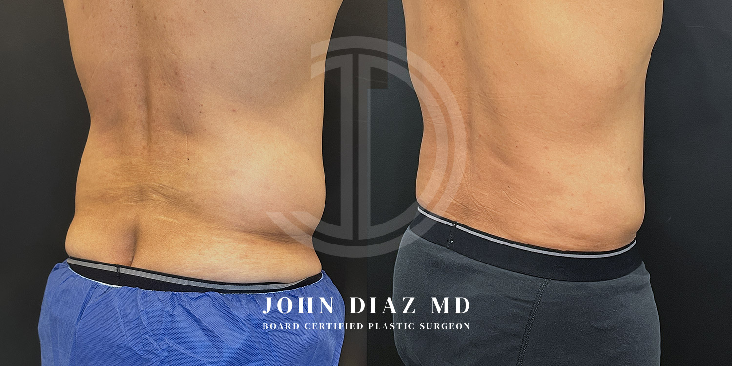 Dr John Diaz Before and After | Liposuction