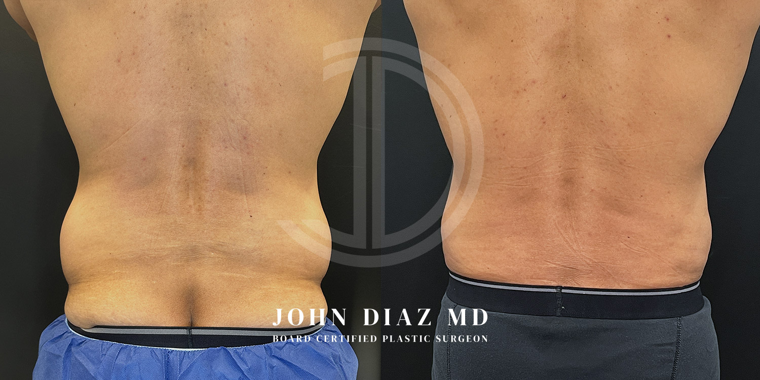 Dr John Diaz Before and After | Liposuction