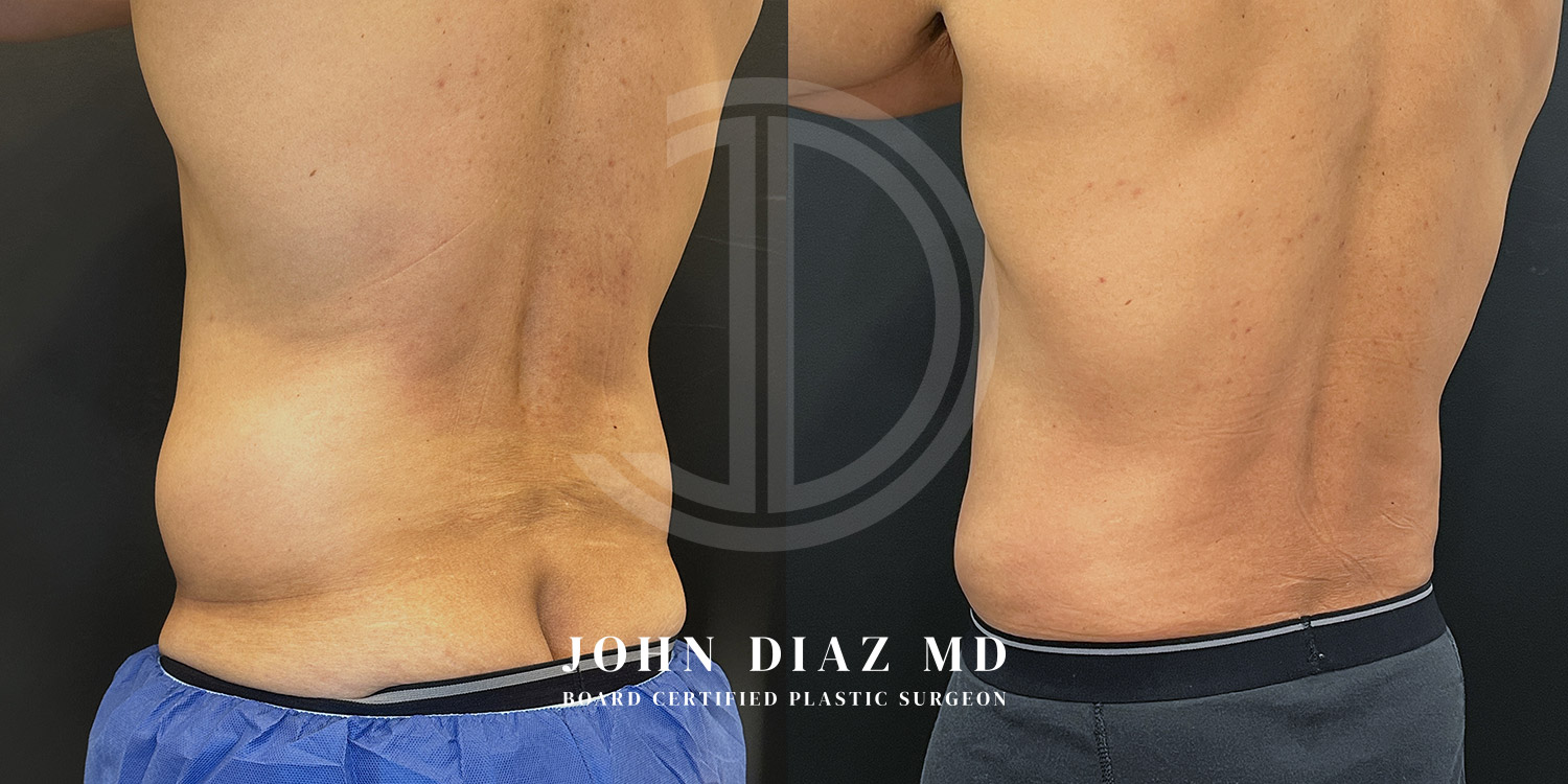 Dr John Diaz Before and After | Liposuction
