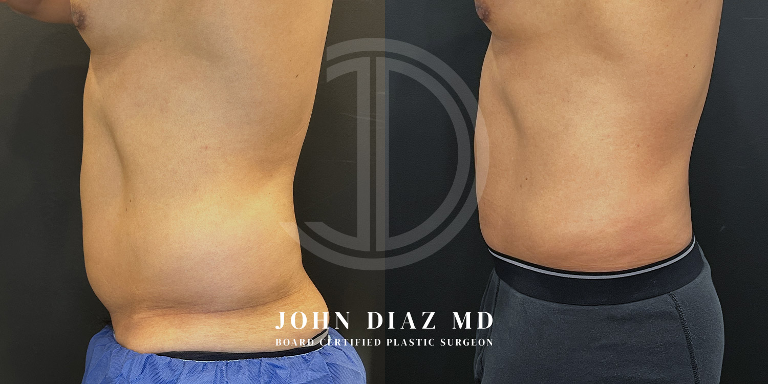 Dr John Diaz Before and After | Liposuction