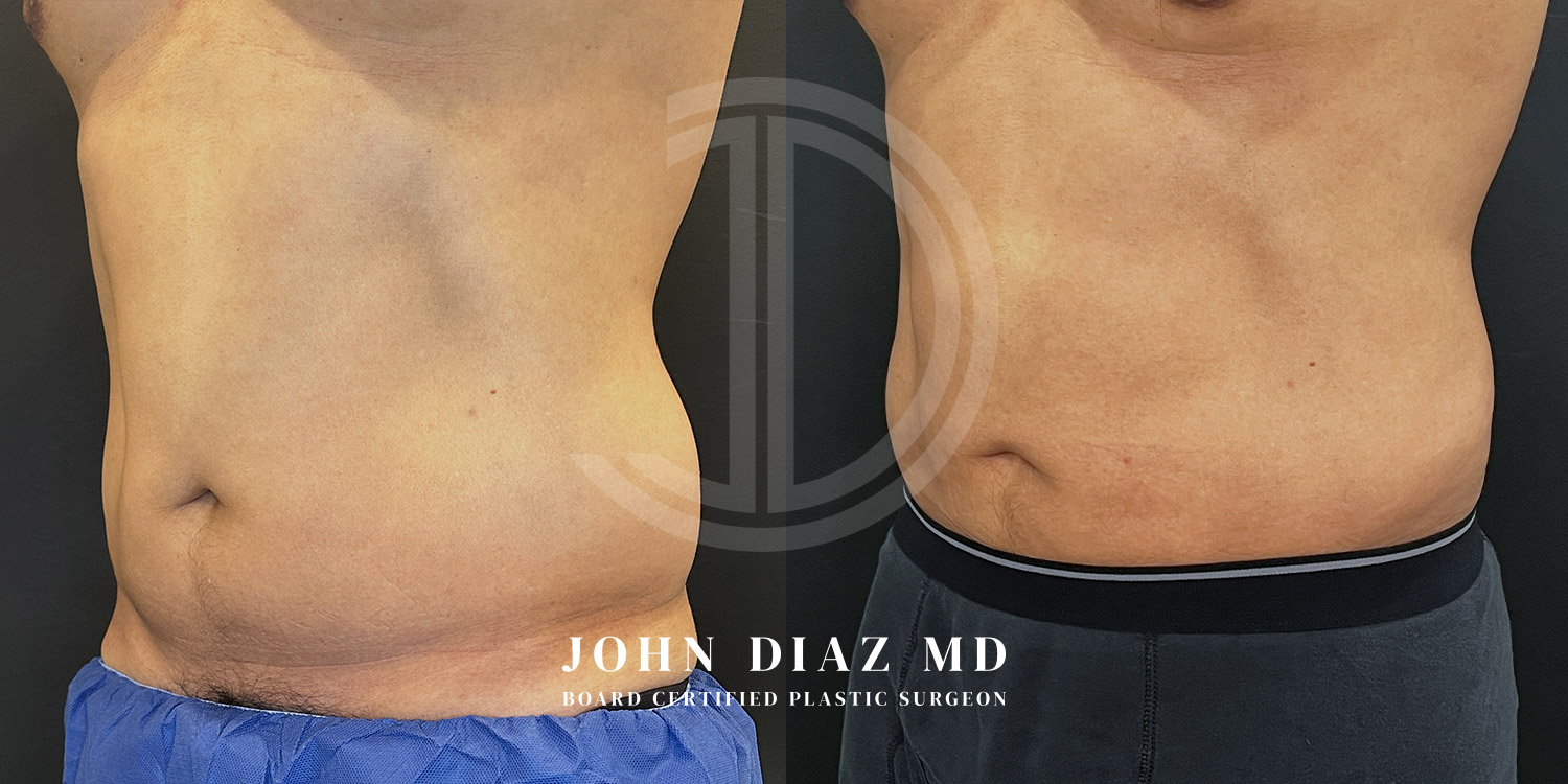 Dr John Diaz Before and After | Liposuction