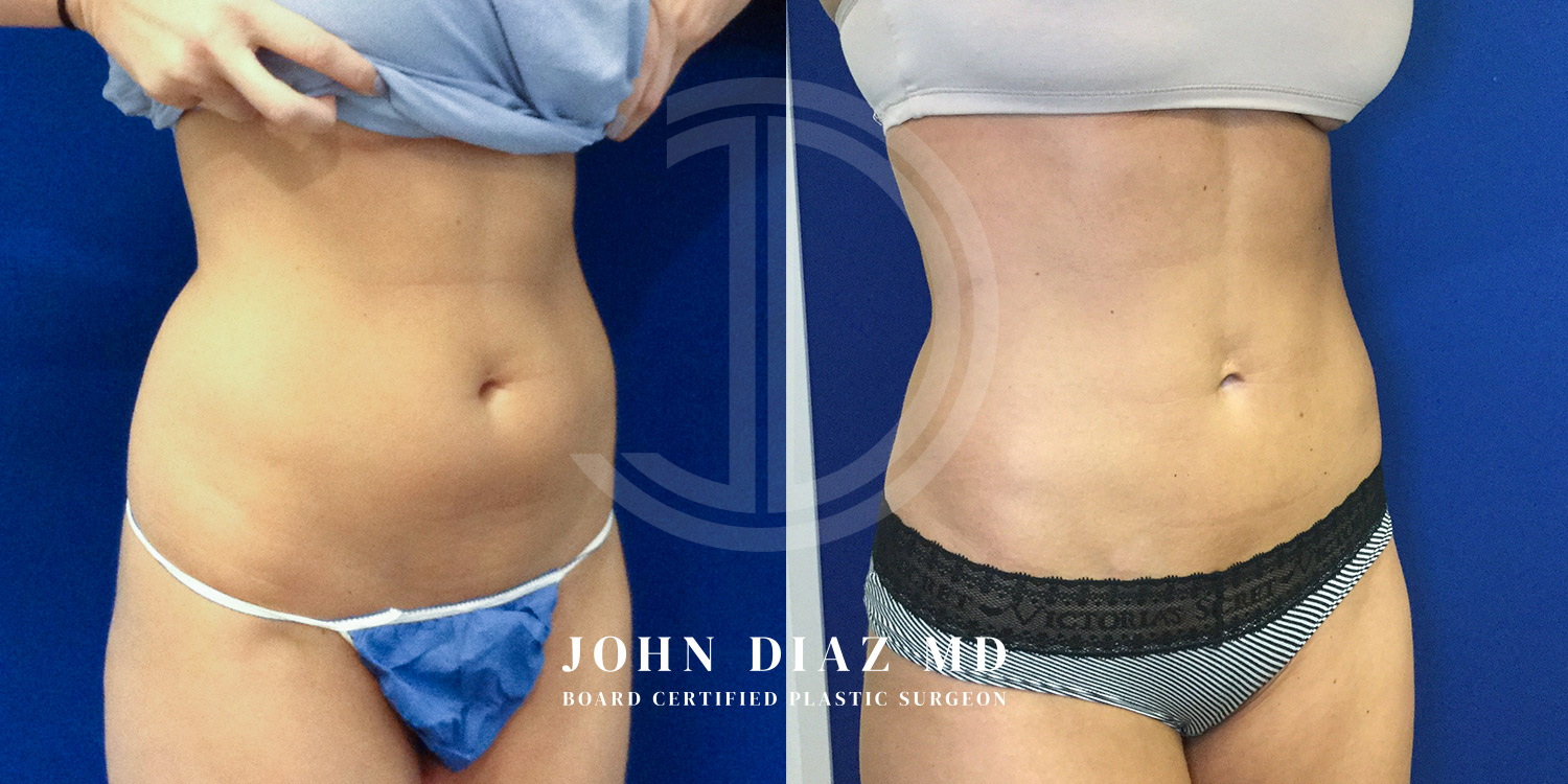 Dr John Diaz Before and After | Liposuction