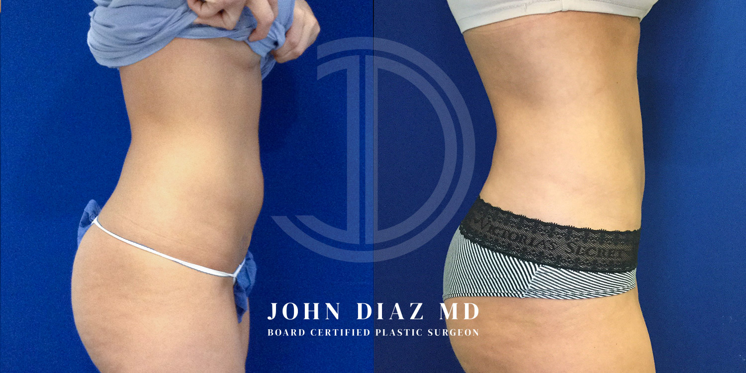 Dr John Diaz Before and After | Liposuction